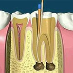 根管治療