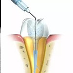 根管治療