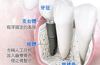 瑞典Astra 種植系統(tǒng)