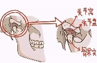 顳下頜關(guān)節(jié)疾病