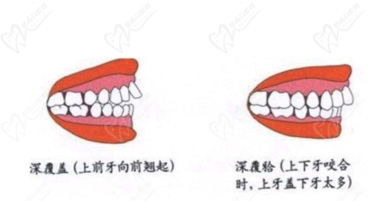 牙齒深覆合和深覆蓋區(qū)別