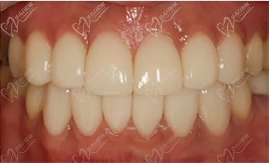 超薄瓷牙貼面術后照片