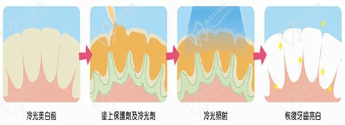 冷光美白過(guò)程