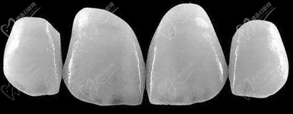 水晶瓷牙貼面