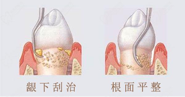齦下刮治、根面平整