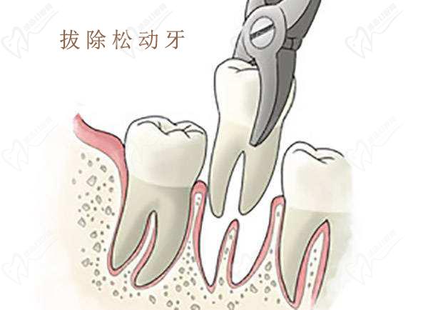 牙齒松動后拔除