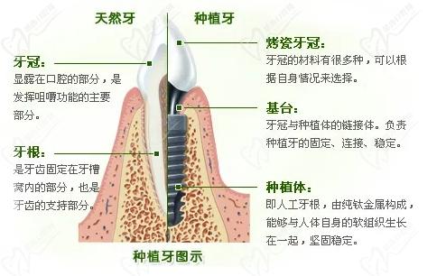 揚州金伯利口腔種植牙靠譜