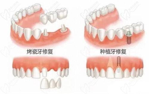 全口假牙修復