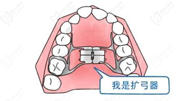 擴弓器