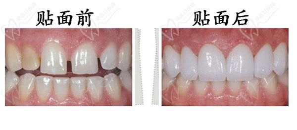 瓷貼面前后對比