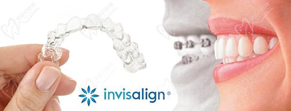 隱形牙齒矯正 品牌不同的區(qū)別
