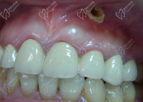 牙齦瘺管是什么樣子圖片
