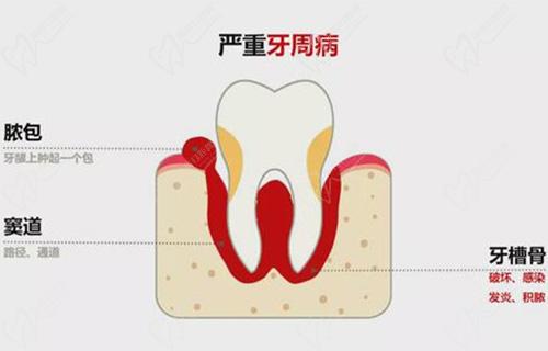 牙齒瘺管長(zhǎng)期不治療有什么危害