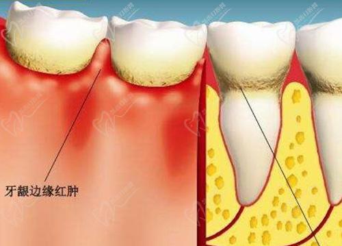 牙齒瘺管怎么治療