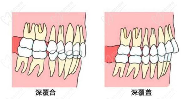 牙齒只深覆蓋正常嗎？深覆蓋有必要矯正嗎？看矯正后臉型變化