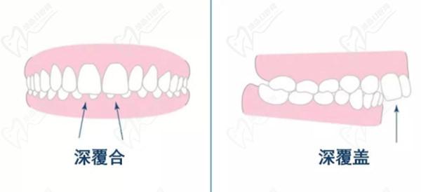 牙齒只深覆蓋正常嗎？深覆蓋有必要矯正嗎？看矯正后臉型變化