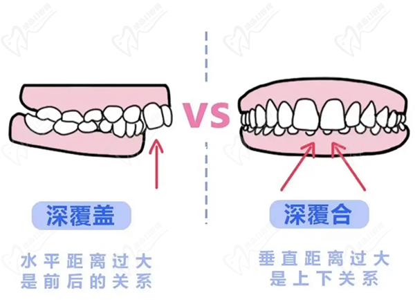 牙齒只深覆蓋正常嗎？深覆蓋有必要矯正嗎？看矯正后臉型變化