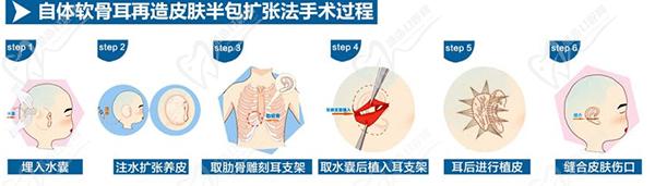 北京麗都耳再造中心耳再造技術(shù)