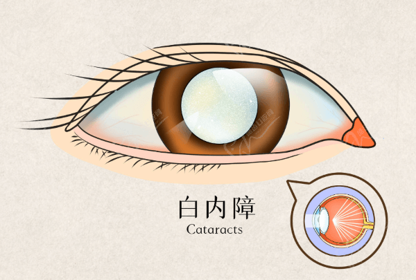 白內(nèi)障手術