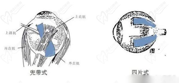 王樂今做后鞏膜加固術(shù)怎樣