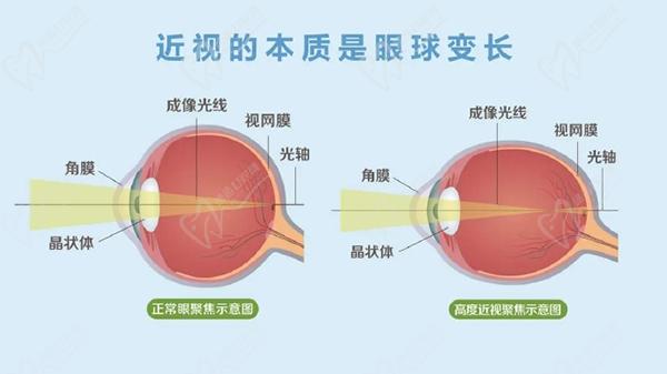 王樂今的微創(chuàng)后鞏膜加固術(shù)怎么樣