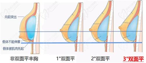 謝衛(wèi)國(guó)假體隆胸不用引流好嗎