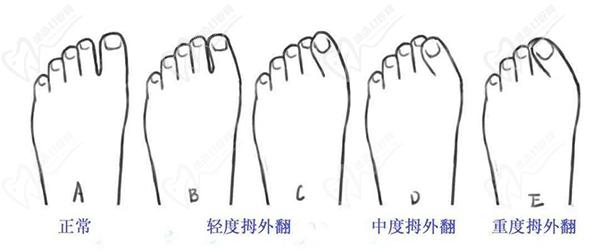 大腳骨手術(shù)的費(fèi)用大概是多少錢啊