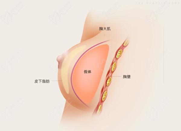 唐志榮做隆胸手術(shù)好