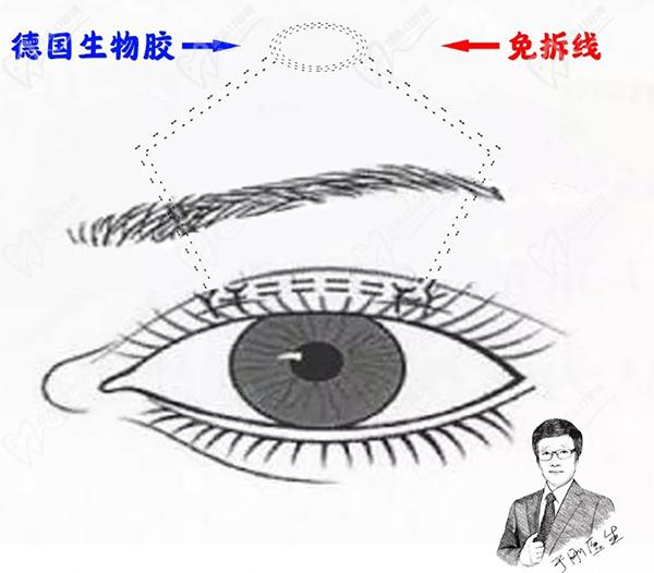 美和眼科于剛做上眼瞼下垂手術(shù)MTS