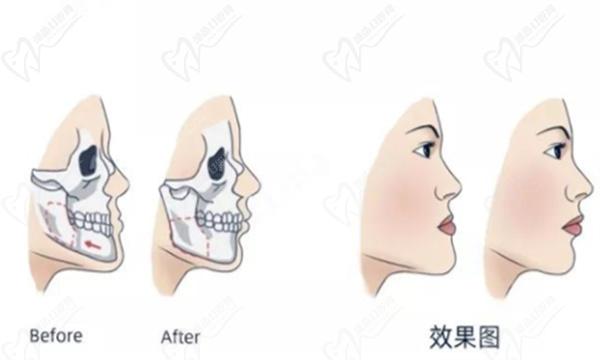 正頜手術