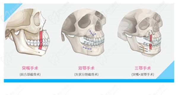 正頜手術