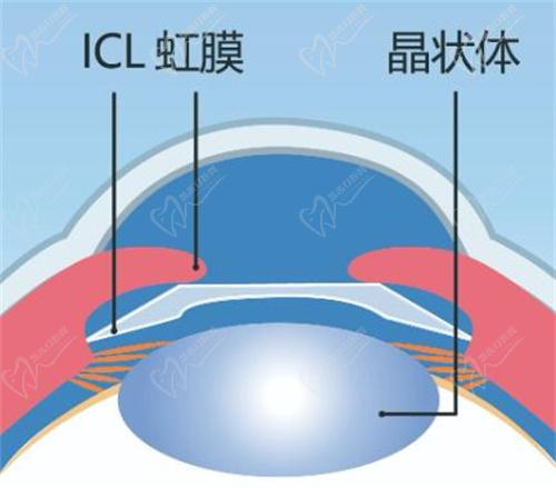 杭州華廈眼科ICL人工晶體植入價(jià)格27000起