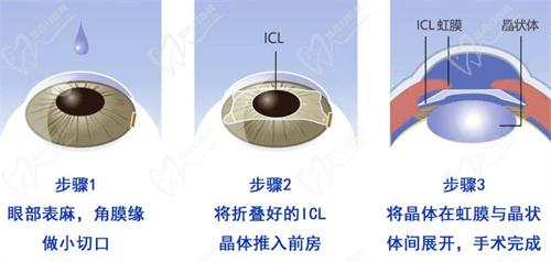 杭州華廈眼科醫(yī)院近視手術(shù)口碑好