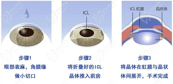 鄭州近視眼手術(shù)價(jià)格一覽表