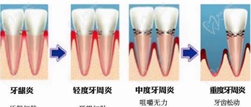 天津口腔醫(yī)院牙周炎刮治費用