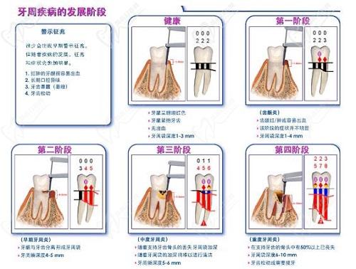 天津口腔醫(yī)院牙周炎刮治費用