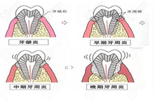 牙周炎
