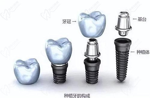 種一顆牙需要多少錢？