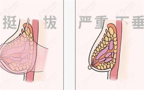 黃廣香和朱云做胸實(shí)例對(duì)比