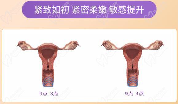 重慶做私密緊縮手術(shù)多少錢