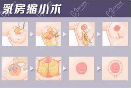 杭州美萊栗勇縮胸手術(shù)好不好