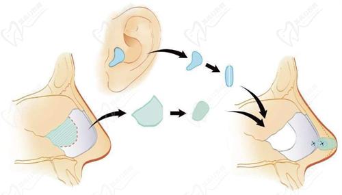 二、耳軟骨隆鼻三年吸收后，有哪些修復(fù)方案？
